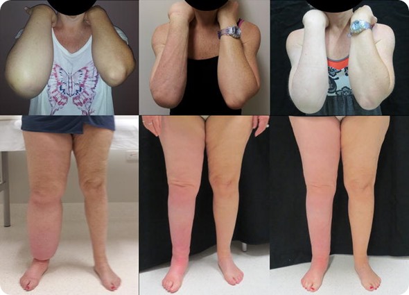 First arm and leg liposuction patients, both right-side affected. Left panel pre-liposuction, middle panel 6 months post-liposuction, right panel 12 months post-liposuction