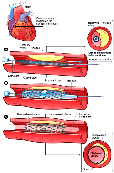 Implanting a Stent