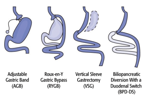 Diagram of Surgical Options. Image credit: Walter Pories, M.D. FACS.