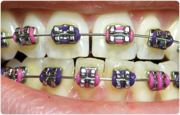 Behind Teeth Braces