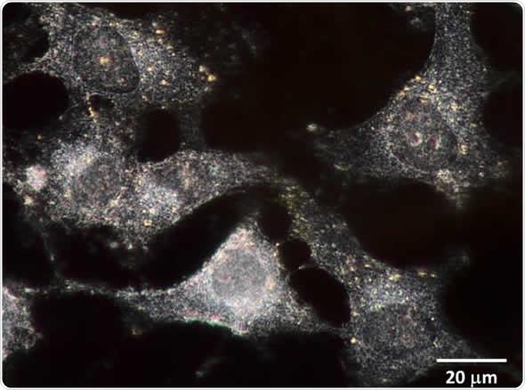 Dark-field image of human breast cancer cells tagged with gold nanoparticles (60nm size).