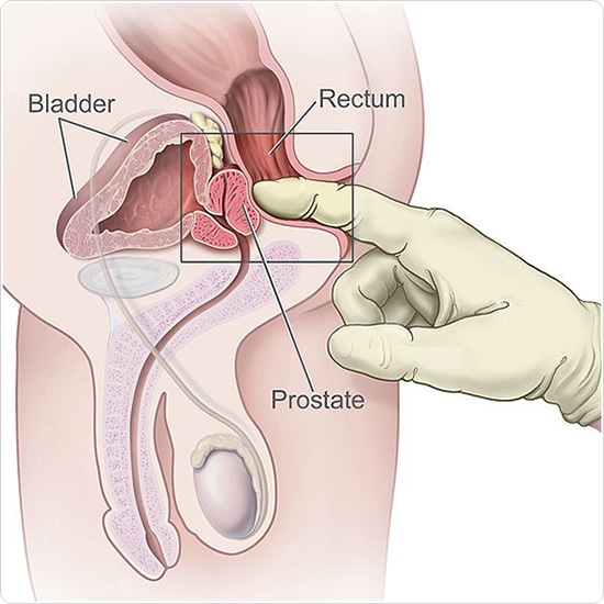 Rectal examination of the prostate