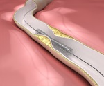 New exosome-coated stent repairs damaged tissue, heals vascular injury