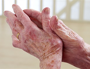 Study identifies an epigenetic regulator that suppresses pathogenic events in rheumatoid arthritis