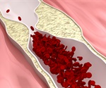 Signs of atherosclerosis seen in apparently healthy young adults
