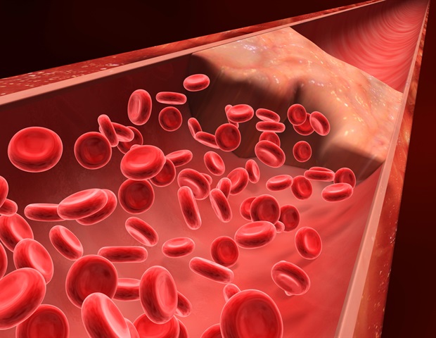 Study offers new insight into increased risk of blood clots in women
