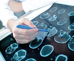 Study reveals the various ways patients with multiple sclerosis acquire disability