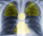 PET radiotracer can noninvasively identify and monitor pulmonary fibrosis