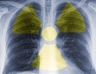 Novel molecular imaging radiotracer can precisely diagnose multiple cancers