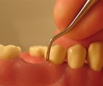 Periodontal disease develops much earlier than dentists and other health professionals thought