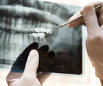 Dental x-rays when pregnant linked to low birth weight