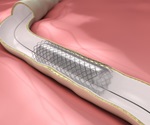 Sirolimus drug-coated stent causes less inflammation than bare metal stents