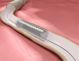 Novel biodegradable magnesium-alloy tracheal stents for children with airway obstruction