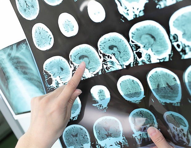 Study: Most patients are getting small doses of rehab therapy after stroke