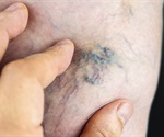 Sclerotherapy now the number two most performed cosmetic surgical procedure thanks to men
