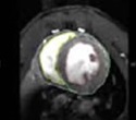 Cardiac MR Imaging to Assess Heart Disease in Mice