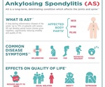 Novartis’ Cosentyx® show no progression in spinal damage in 80% of ankylosing spondylitis patients