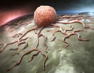 Novel T cell receptor therapy shows early promise for treating solid tumors
