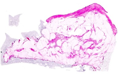 Image of whole-mount breast cancer specimen