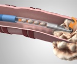 Medtronic launches GenCut Core Biopsy System for minimally invasive use with the superDimension navigation system for lung tissue biopsies
