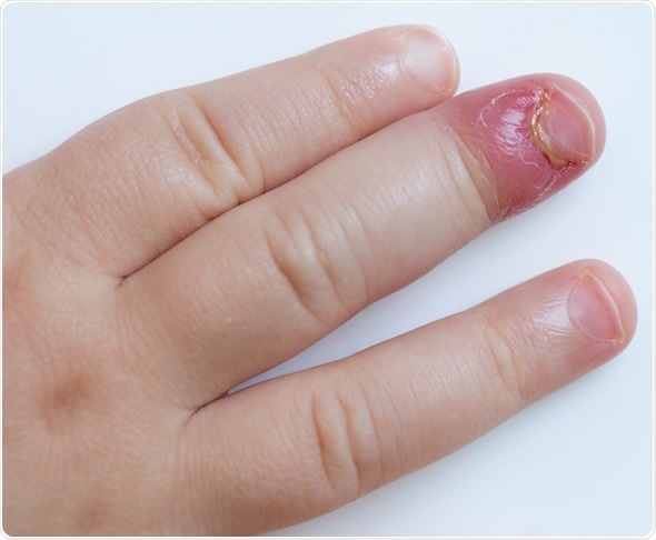 Paronychia, swollen finger with fingernail bed inflammation due to bacterial infection on a toddlers hand. - Image Copyright: zlikovec / Shutterstock