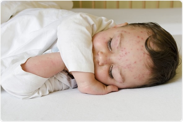 Sleeping child with red spots on his skin of chicken pox. Image Copyright: pavla / Shutterstock