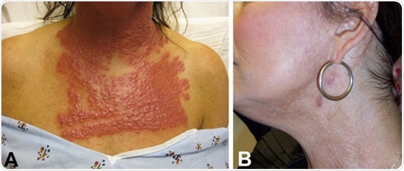 A) Neck and chest of a 53-year-old woman (case-patient 1) 14 days after fractionated CO2 laser resurfacing. B) Neck of the patient after 5 months of multidrug therapy and pulsed dye laser treatment. Image Credit: CDC