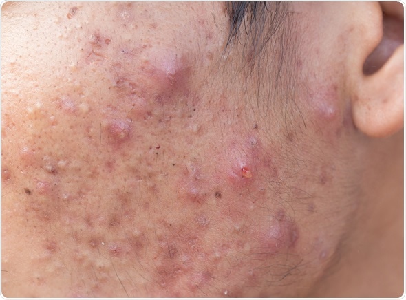 Man with problematic skin and scars from acne (scar). Image Copyright: frank60 / Shutterstock
