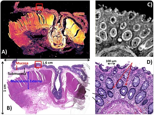 Spero QCL‐based infrared imaging of a colorectal microtome tissue section (192 mm2 in size). A) IR chemical image of the entire section recorded at 1656 cm‐1. The mosaic image was acquired in 3.8 minutes using the enhanced 4X magnification objective having a FOV of 2 x 2 mm2, pixel size of 4.25 μm and diffraction‐limited resolution of about 12 μm at the amide I band. B) Brightfield image of the parallel H&E stained section. C) IR chemical image at a FOV that describes the mucosa recorded at 1656 cm‐1. The image was acquired using the 12.5X magnification objective having a 650 x 650 μm2 FOV, 1.36 μm pixel size and diffraction‐limited resolution of 5 μm at the amide I band. D) Brightfield 10X magnification image of the parallel H&E stained section shown in C. Red arrows indicate colonocytes. Black arrows indicate goblet cells.