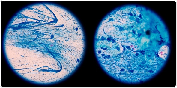 Mycobacterium tuberculosis is a pathogenic bacterial species in the family Mycobacteriaceae and the causative agent of most cases of tuberculosis,in left AFB 1+,in right AFB 2+. Image Copyright: toeytoey / Shutterstock