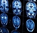 Three rapid-launch research initiatives seek to advance the development of brain health metrics
