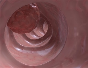 Intestinal microbiome may contribute to the pathogenesis of MSI colon cancers, study suggests