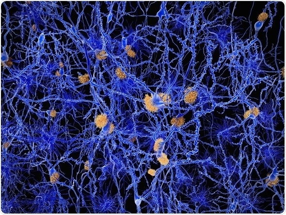 Alzheimer disease neuron network with amylod plaques.