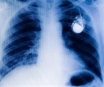 Deep learning model uses a single chest X-ray to predict heart disease risk