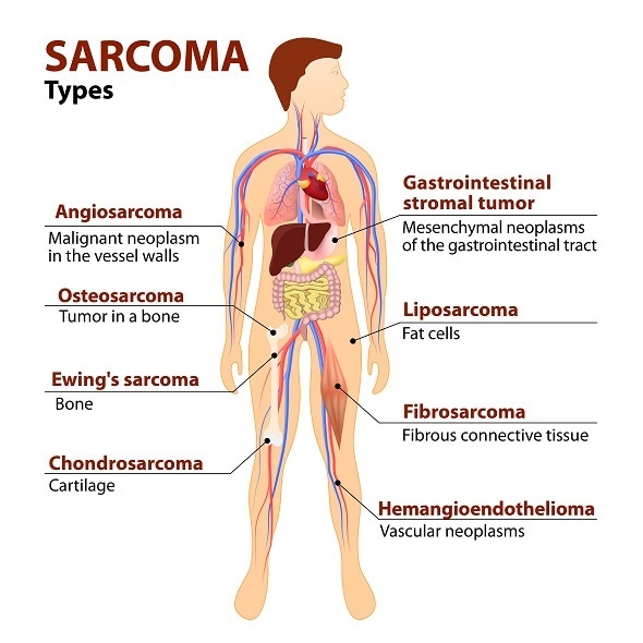 Soft Tissue Sarcoma Symptoms, Risk Factors, and Diagnosis