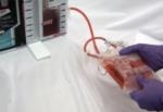 Autotransfusion Blood Bags from Atrium