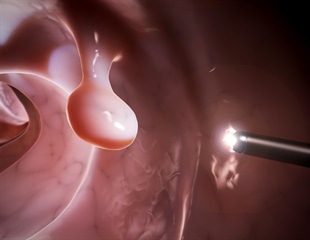 Clinical study reveals safety and efficacy of novel investigational colonoscopy prep