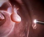 Ingesting blue dye tablet during colonoscopy aids in detecting difficult-to-see polyps