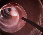 Patient interventions with low-income and minorities increases colonoscopy rates