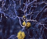 Alzheimer’s research raises questions on the role of infection