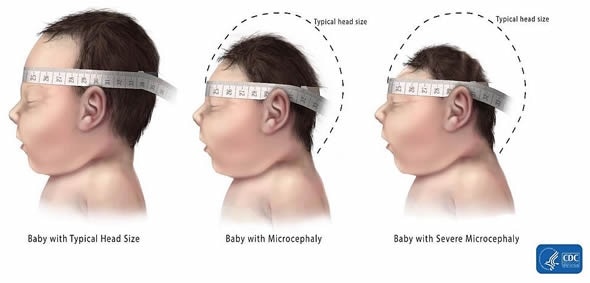 Measuring Head Circumference in Microcephaly