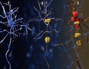 Alzheimer’s disease risk genes disturb the brain protective mechanism