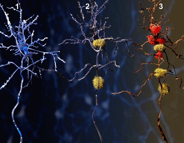 Unraveling the mystery of Alzheimer's resilience at molecular level