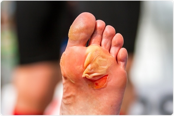 Big blister on foot after woman finished triathlon