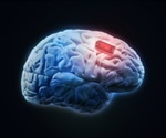 Study: Epilepsy brain implant does not induce changes to patients' personalities or self-perceptions