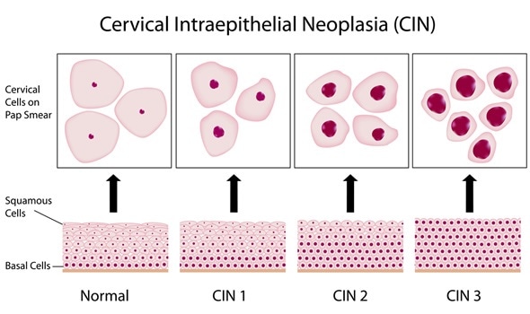 Cervical dysplasia stages and cervix cell morphology on pap smear test, Image Copyright: Alila Medical Media / Shutterstock