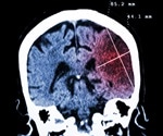Effects of Huntington's disease mutation more complex than originally thought