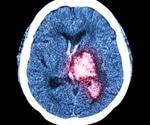 Regular exercise may reduce bleeding in individuals with intracerebral hemorrhage