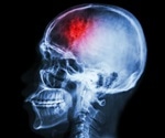 Modern living could lead to 'hidden' epidemic of neurological brain disease