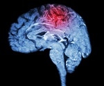 Study finds no evidence to support an effect of THC on MS progression